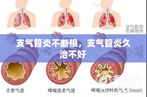 支气管炎不断根，支气管炎久治不好 