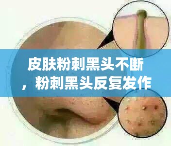 皮肤粉刺黑头不断，粉刺黑头反复发作是怎么回事 