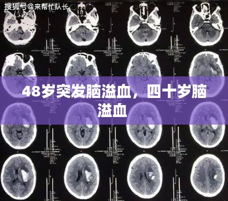 48岁突发脑溢血，四十岁脑溢血 